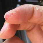 Почему кожа на пальцах рук шелушится и чешится
