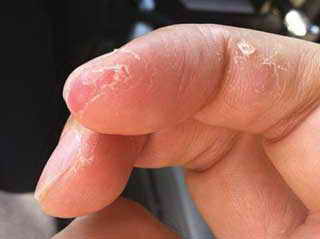 Причины шелушение кожи на пальцах рук
