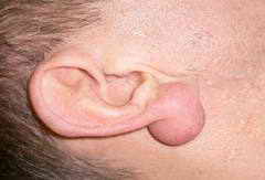 Как лечится атерома мочки уха?