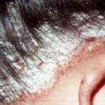 Лечение псориаза волосистой части головы