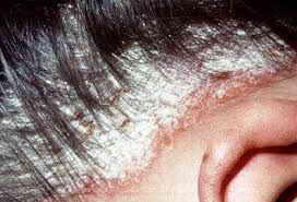 Лечение псориаза волосистой части головы