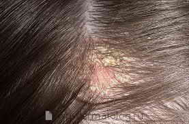 Лечение демодекоза волосистой части головы