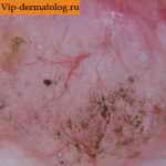 базально-клеточный рак кожи