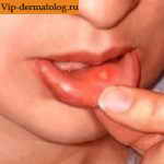 налет на слизистой губ 