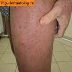 атопический дерматит на ногах