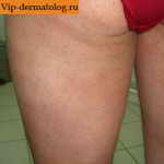 Гиперэозинофильный синдром на ноге
