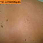 гиперэозинофильный дерматит на спине