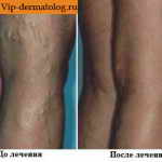 До и после лечения варикозного расширения вен на ногах