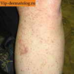 аллергия на коже голеней