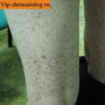 васкулит кожи аллергический