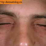 аллергический дерматит на глазах