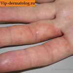 аллергический дерматит на руках