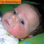 контактный дерматит у детей