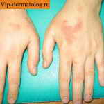 контактный дерматит у детей на руках