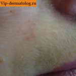 Периоральный дерматит над губой