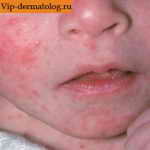 Себорейный дерматит у ребенка