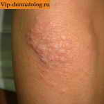 Заболевание шистосомный дерматит