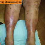 застойный дерматит на ногах