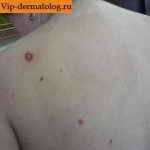 дерматофиброма на коже спины