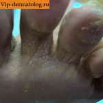 дерматофитии стопы