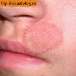 дерматофития на лице под носом