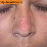 дерматофития на лице