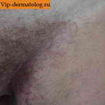 микоз гладкой кожи фото лечение