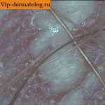 Фото лечения микоза крупных складок