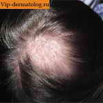 трихофития волосистой части головы