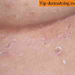 лечение кандидоза кожи 