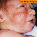 токсическая эритема новорожденных на лице
