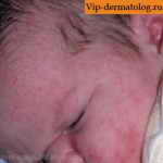 токсическая эритема новорожденных на щеке