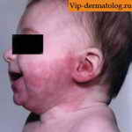 токсическая эритема новорожденных от рта до уха
