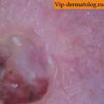 плоскоклеточный ороговевающий рак кожи