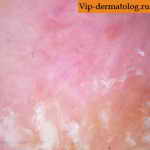 плоскоклеточный рак кожи