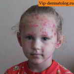 стрептодермия на лице у ребенка