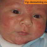 стрептодермия в носу у ребенка