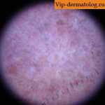 наследственная кератодермия под микроскопом