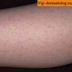 кератоз фолликулярный кожи у ребенка