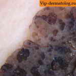 Себорейный черный кератоз
