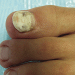 Лечение микоза ногтей