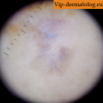 беспигментная меланома под микроскопом