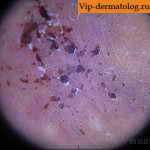 криоглобулинемия под микроскопом