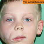 лимфангиома фото у ребенка