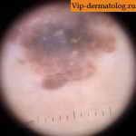 меланоакантомы под микроскопом