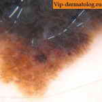 внутридермальный меланоцитарный невус кожи