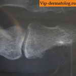 костная мозоль на рентгене фото