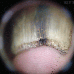 Аспергиллез ногтя фото