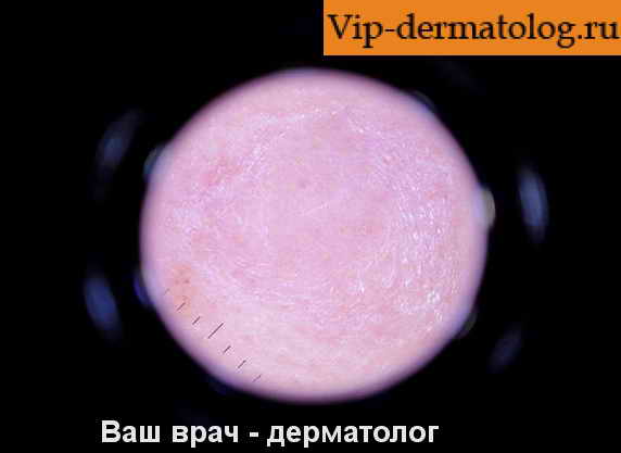 Доброкачественная лимфоплазия кожи. Признаки доброкачественной лимфоплазии кожи.