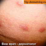 лимфоплазия кожи фото